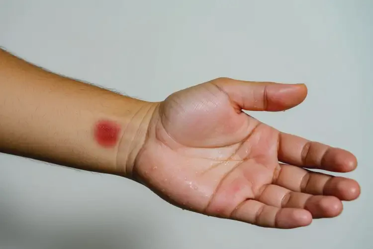 男生身上出濕疹不管它會自己好嗎(圖3)