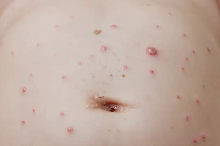 幼兒肚子上長濕疹能徹底自愈嗎(圖4)