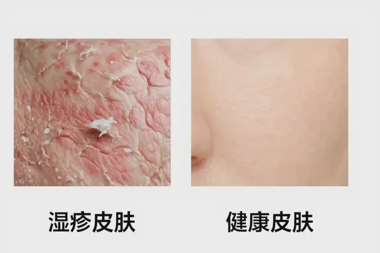 小孩肚子偶爾長(zhǎng)濕疹能徹底自愈嗎(圖2)