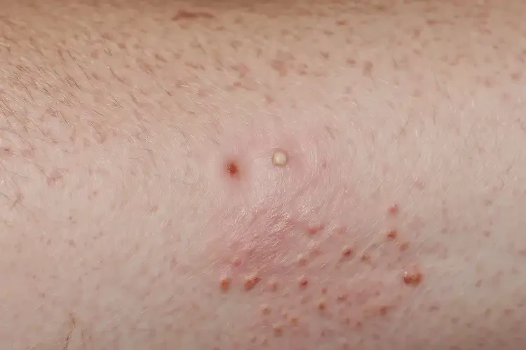 男生全身有濕疹不管它會(huì)自己痊愈嗎(圖4)