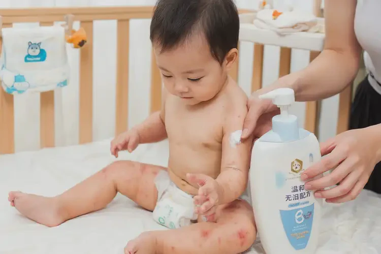 幼兒大腿經(jīng)常起濕疹可不可以根治(圖2)
