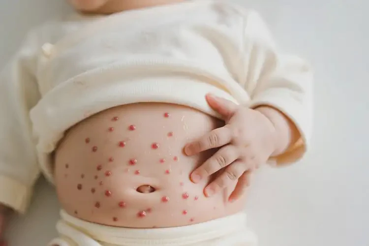 嬰兒肚子上出現(xiàn)濕疹可不可以根治(圖3)