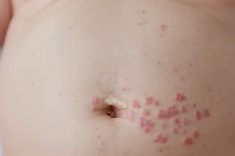 新生兒肚子起濕疹能徹底自愈嗎(圖4)