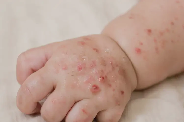 寶寶手上偶爾長濕疹不管它會自己好嗎(圖3)