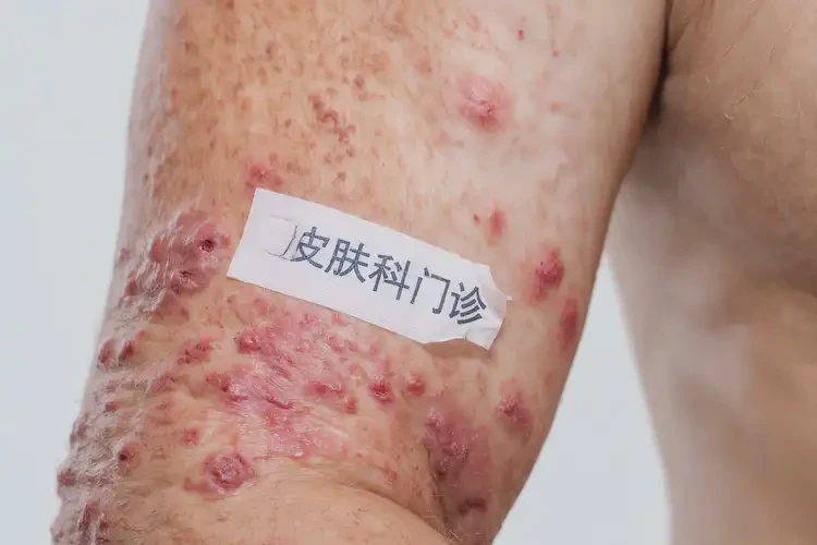 男性手臂上起濕疹不管它會自己自愈嗎(圖4)