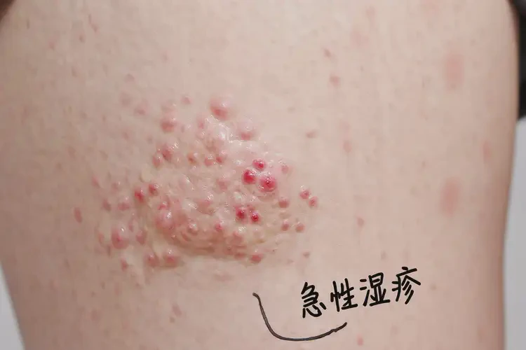 大學(xué)生大腿上有濕疹能徹底自愈嗎(圖4)
