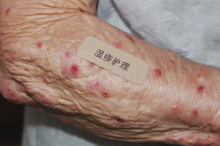 高齡老人屁股上經(jīng)常長(zhǎng)濕疹可以徹底自愈嗎(圖4)