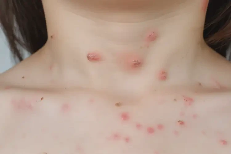 小兒脖子上容易起濕疹能夠徹底治愈嗎(圖4)