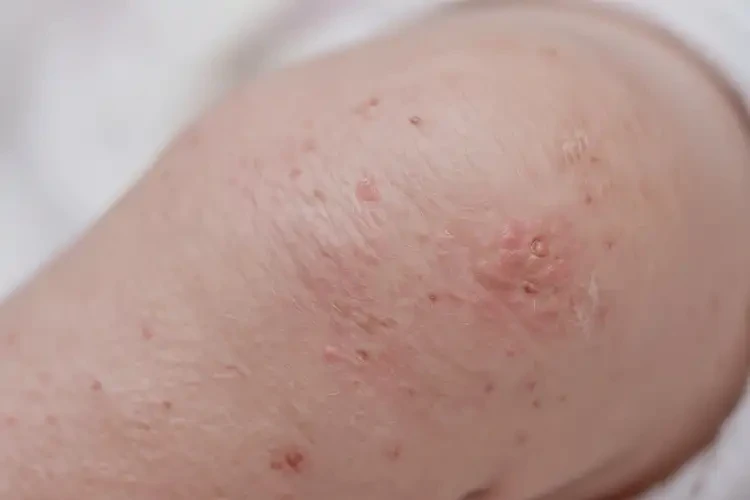 新生兒大腿上偶爾長(zhǎng)濕疹不管它會(huì)自己好嗎(圖4)