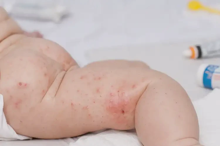 寶寶肛周容易起濕疹能靠自己自愈嗎(圖4)