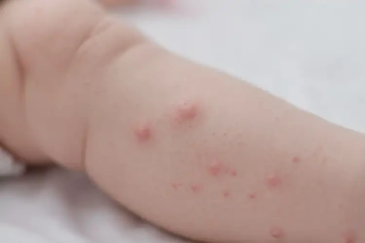 新生儿小腿上偶尔长湿疹可以彻底自愈吗(图4)