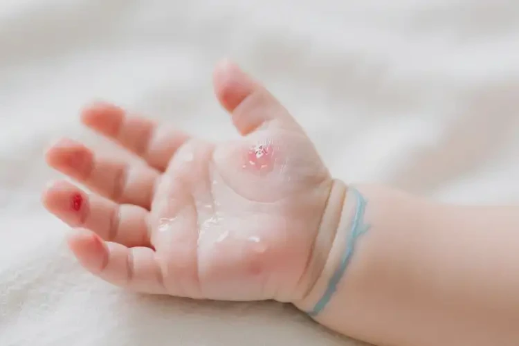 新生兒手上長(zhǎng)濕疹可不可以根治(圖3)