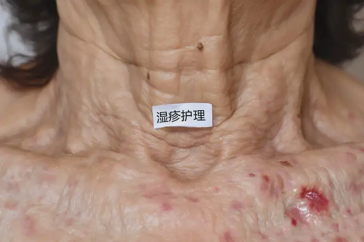 老年人脖子上容易長(zhǎng)濕疹可以徹底自愈嗎(圖3)