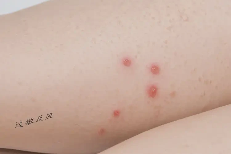 女人大腿上經(jīng)常起濕疹能不能根治(圖4)