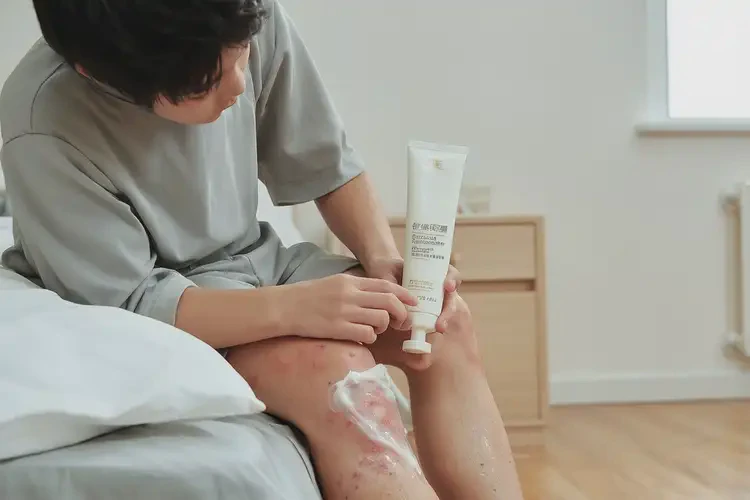 青少年小腿上偶爾起濕疹可不可以根治(圖2)