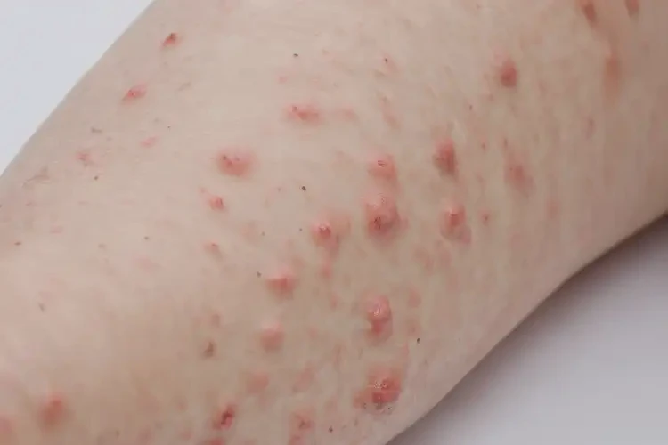 小孩大腿上經(jīng)常起濕疹能夠徹底治愈嗎(圖4)