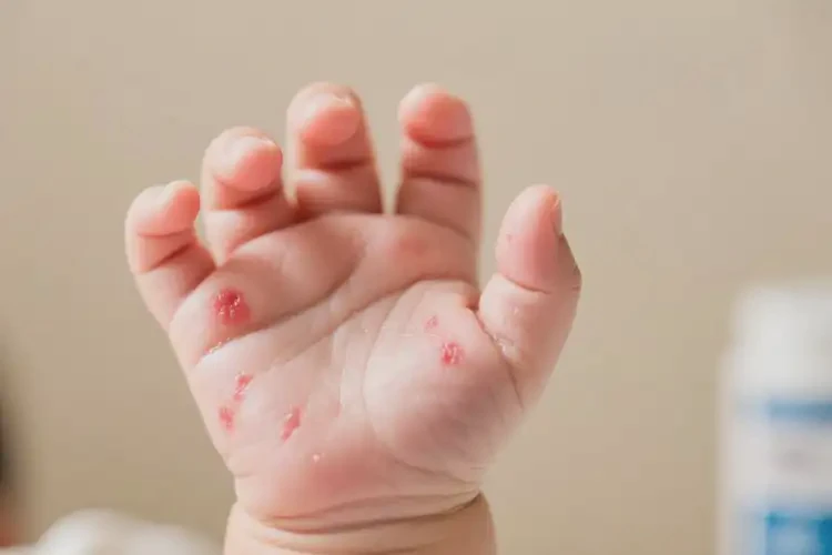 嬰兒手上偶爾長(zhǎng)濕疹可不可以根治(圖4)