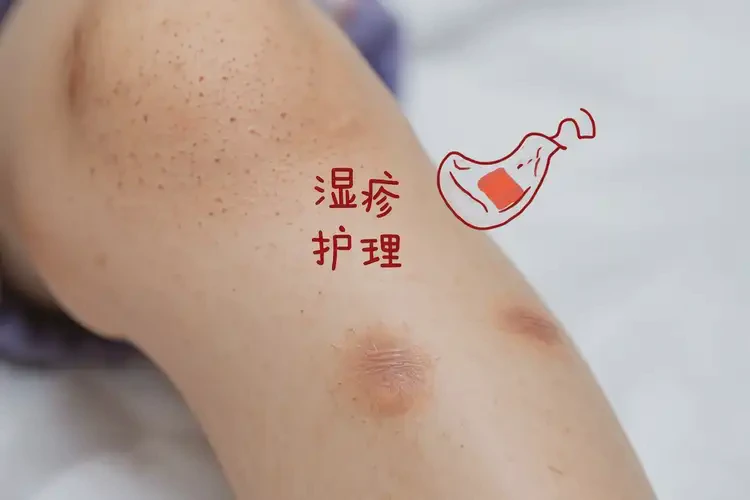 兒童小腿出現(xiàn)濕疹可不可以根治(圖4)