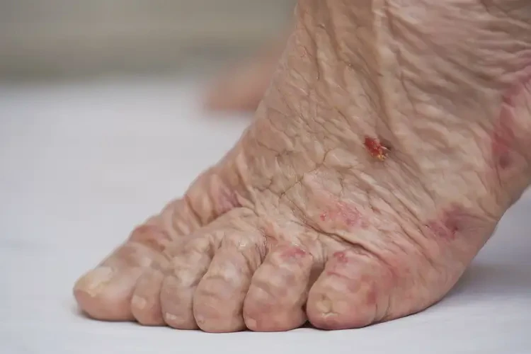 高齡老人腳上出現(xiàn)濕疹能不能根治(圖4)