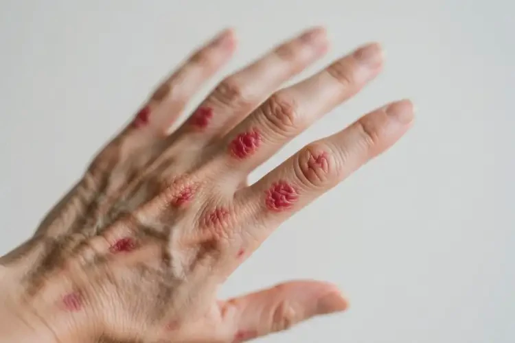 女人手上出現(xiàn)濕疹能不能根治(圖4)