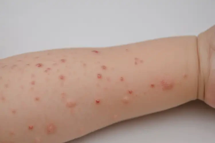 兒童全身偶爾起濕疹不管它會自己自愈嗎(圖4)