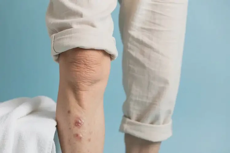 老人大腿上經(jīng)常長(zhǎng)濕疹可不可以根治(圖2)