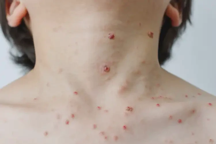 青少年脖子出現(xiàn)濕疹能徹底自愈嗎(圖4)