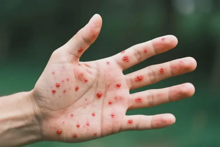 男性身上長濕疹能靠自己自愈嗎(圖1)