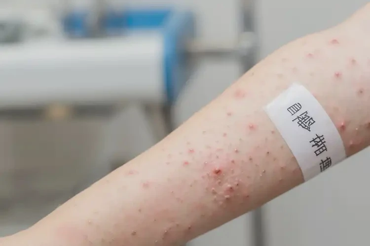 小兒手臂偶爾起濕疹可不可以根治(圖4)