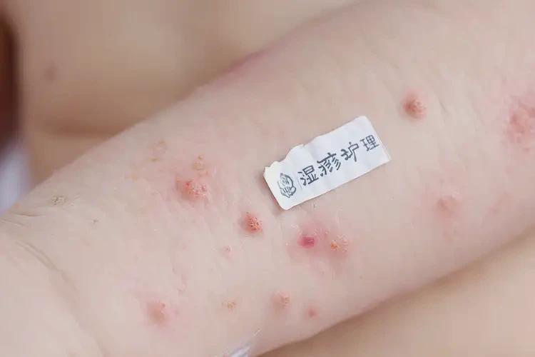 孩子四肢有湿疹可不可以彻底自愈(图4)