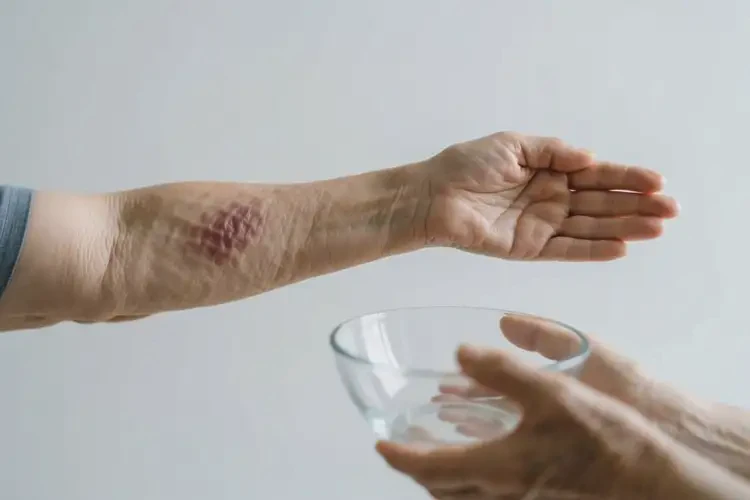 高齡老人手臂起濕疹能不能根治(圖1)