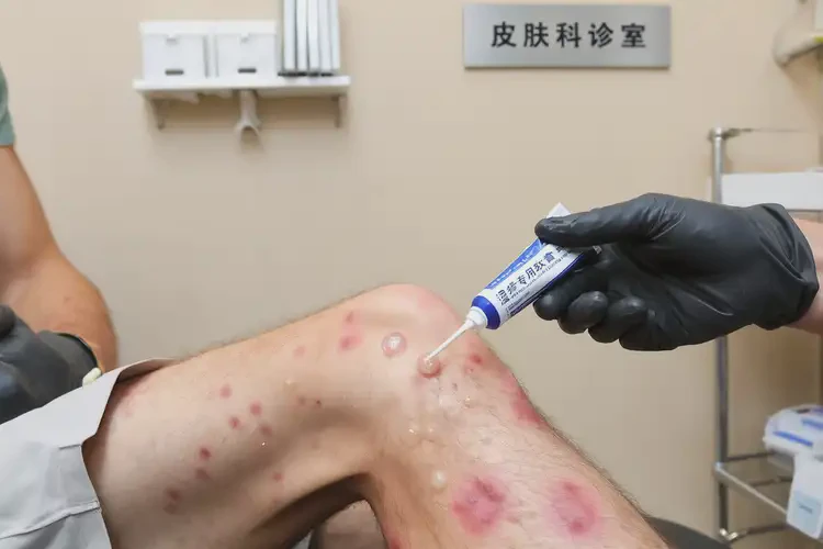 男人大腿上起濕疹不管它會(huì)自己自愈嗎(圖3)