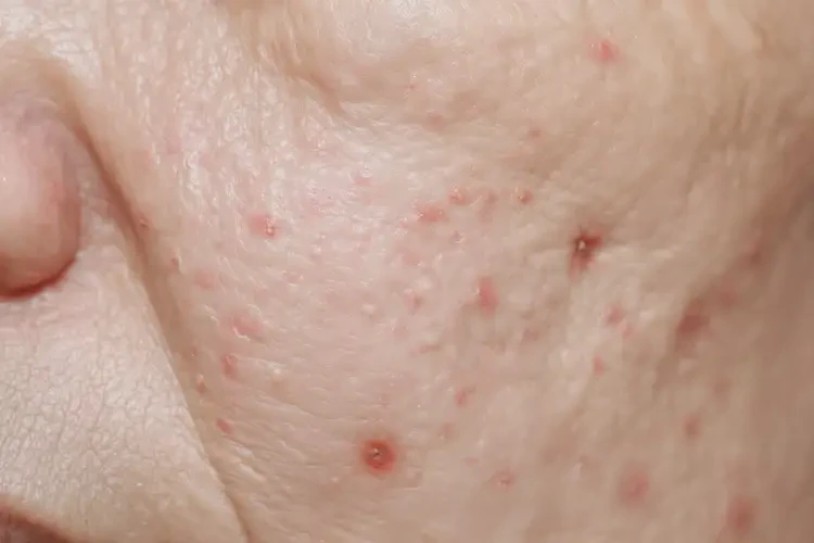 老年人小腿偶爾起濕疹可不可以根治(圖4)