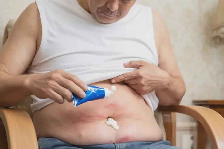 男人肚子偶爾起濕疹能不能根治(圖2)