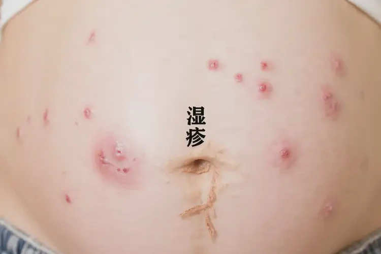 孕妇肚子长湿疹可不可以根治(图4)