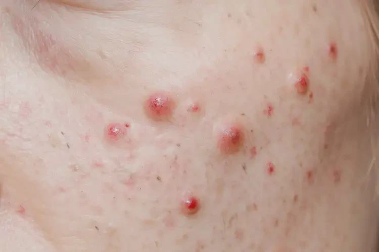 男生肛周有濕疹不管它會自己痊愈嗎(圖4)