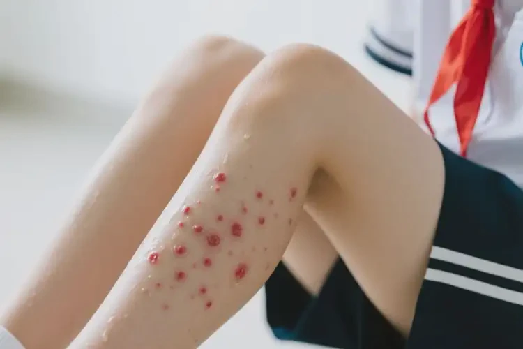 中學(xué)生大腿出現(xiàn)濕疹可不可以根治(圖4)