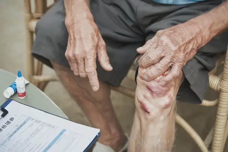 高齡老人小腿上經(jīng)常長濕疹不管它會自己好嗎(圖4)