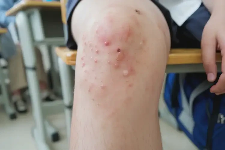 中學(xué)生腳上經(jīng)常起濕疹可不可以根治(圖4)