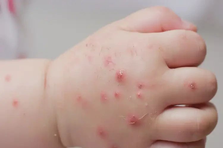 幼兒手上出濕疹可不可以徹底自愈(圖4)