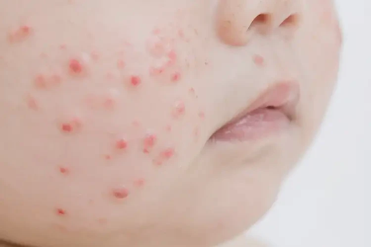 男生面部起濕疹可不可以根治(圖4)