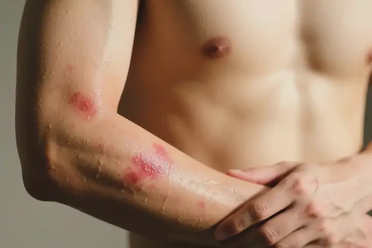 男人手臂上出現濕疹能不能根治(圖3)
