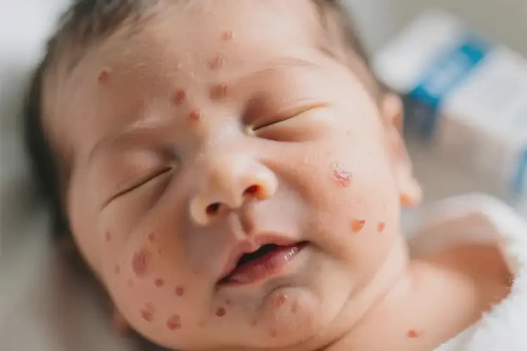 新生儿面部偶尔长湿疹可不可以根治(图4)