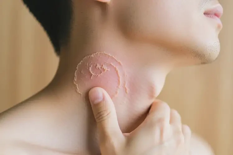 男人脖子上經(jīng)常起濕疹能不能根治(圖1)