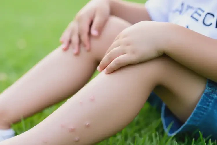 孩子身上偶爾起濕疹可不可以根治(圖2)