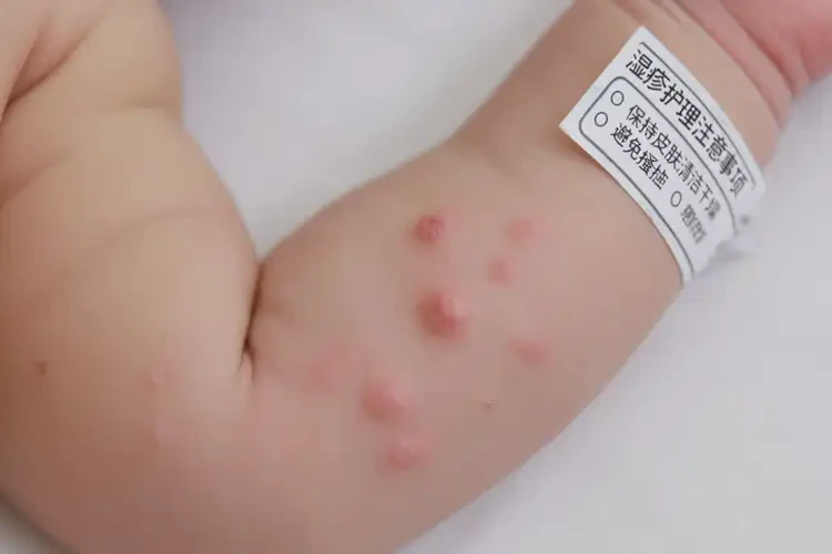 新生兒手臂有濕疹可不可以根治(圖4)