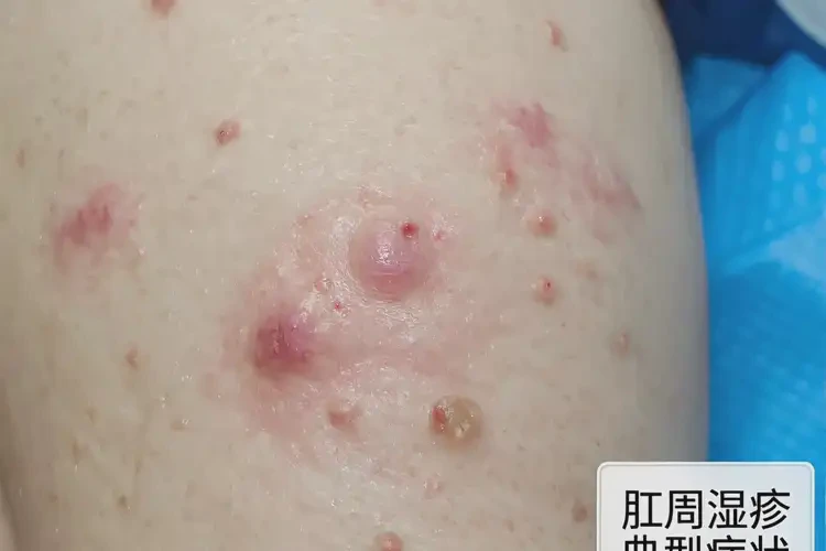 男生肛周出湿疹可不可以根治(图4)