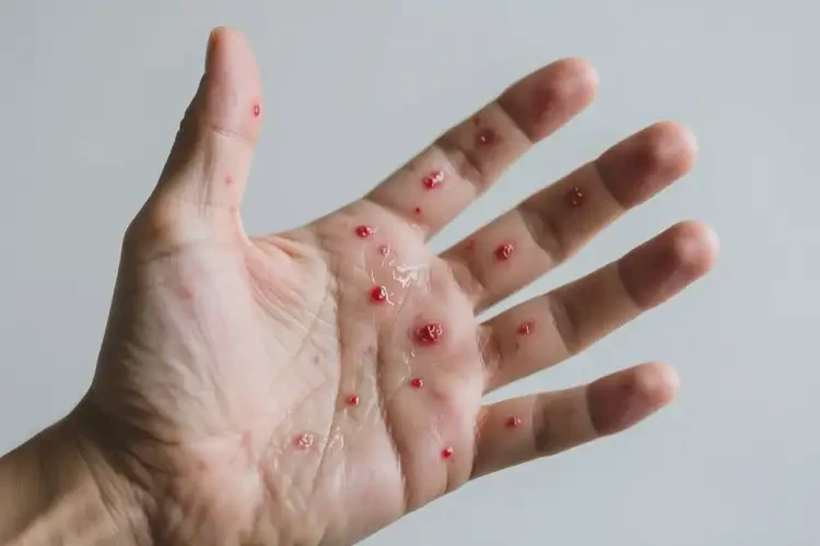 男人手上容易起濕疹不管它會自己痊愈嗎(圖1)