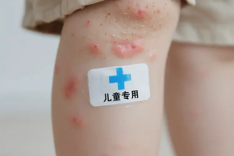 孩子大腿上容易起濕疹可不可以根治(圖4)