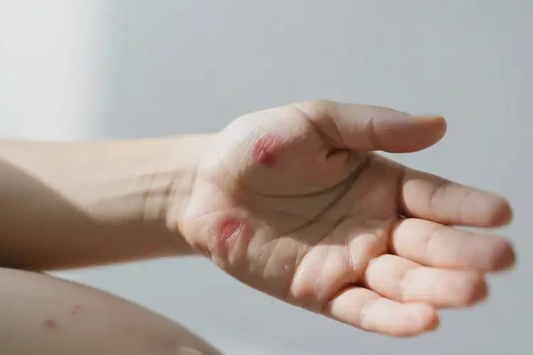 產(chǎn)婦手臂偶爾起濕疹不管它會自己自愈嗎(圖4)